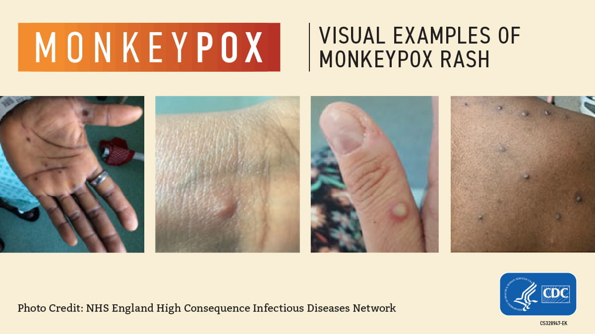 Monkeypox-Visuals-1200x675.jpg