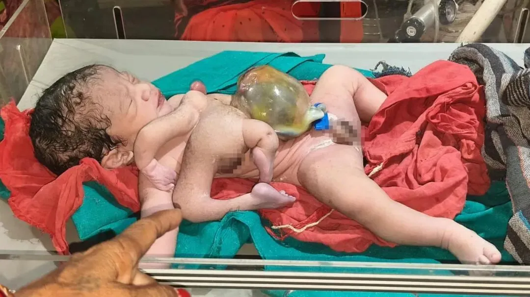 印度婴儿长出4条胳膊4条腿？！腹部连着另一个躯体，就是没有头...